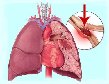 Смерть во сне: как тромбы могут стать неожиданным последствием