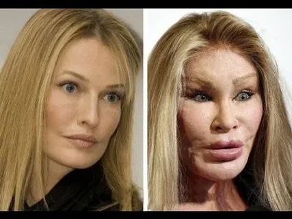 Пластические операции и их неожиданные последствия: Звезды, которые стали жертвами собственных желаний